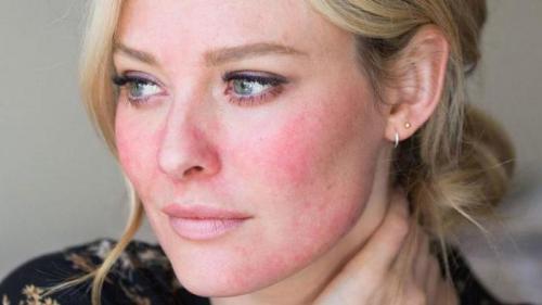 Крем солантра аналог. Солантра (крем): отзывы, инструкция, цена, состав, аналоги