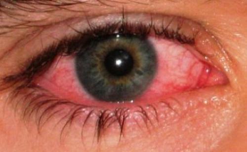 Чайный компресс для глаз. Делаем правильно чайные компрессы 01