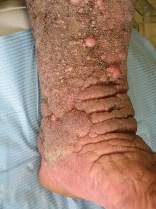 Все кожные заболевания в картинках. Карциноидный папилломатоз кожи Готтрона