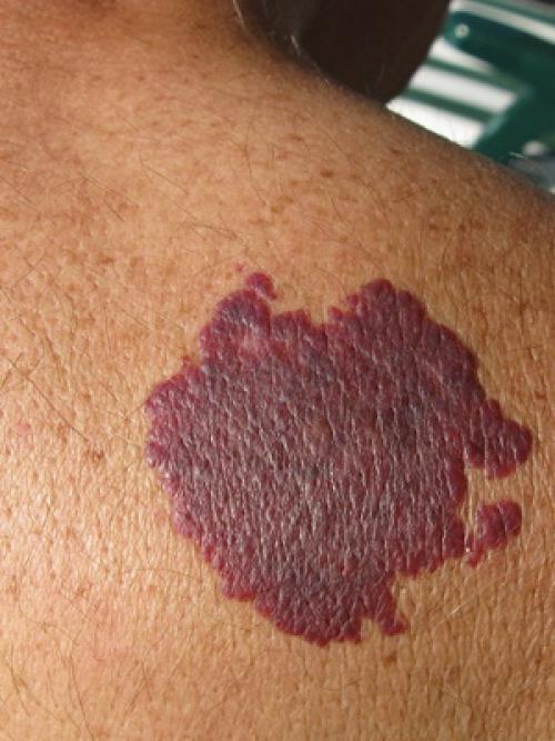 Все кожные заболевания в картинках. Карциноидный папилломатоз кожи Готтрона