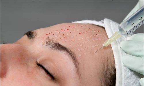 Как подтянуть овал лица косметология. Обзор эффективных способов подтяжки овала лица: борьба с птозом и дряблостью кожи