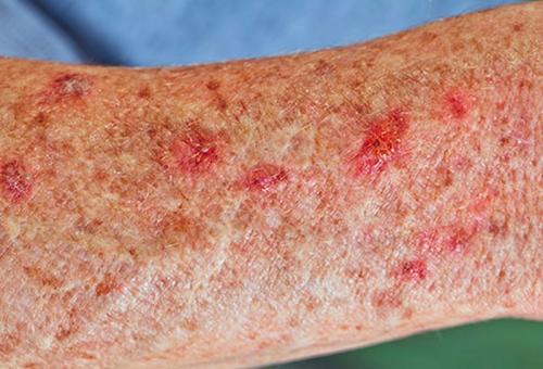 Возрастная кожа. возрастные изменения и 15 болезней кожи