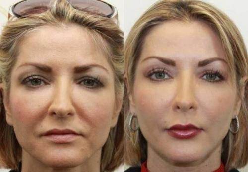 Даже самая дряблая кожа лица подтянется. Даже очень дряблая кожа лица после этой процедуры подтянется! Делайте это 1 раз в неделю
