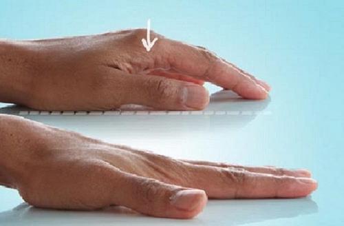 Лфк для пальцев рук. 14 упражнений для пальцев рук при артрозе и артрите