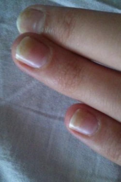 Если отслаивается гель, что делать если. Почему отслаивается гель-лак от ногтей: причины и особенности