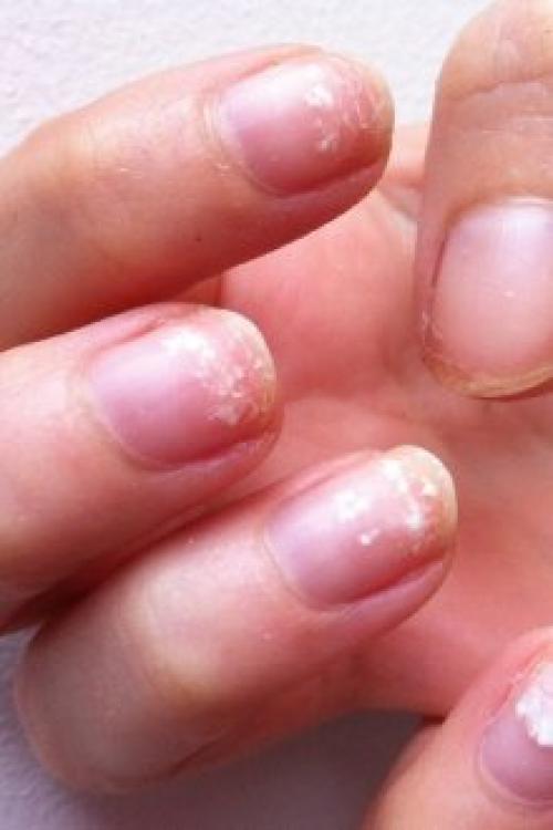Если отслаивается гель, что делать если. Почему отслаивается гель-лак от ногтей: причины и особенности