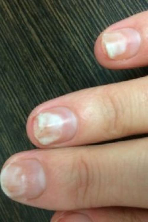 Если отслаивается гель, что делать если. Почему отслаивается гель-лак от ногтей: причины и особенности