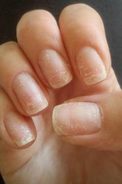 Если отслаивается гель, что делать если. Почему отслаивается гель-лак от ногтей: причины и особенности