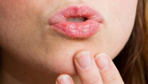 Сохнут и трескаются губы причина у мужчин. Почему сильно трескаются губы? Причины и лечение распространенной проблемы