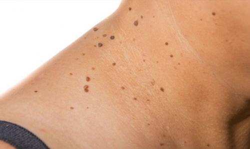 Родинки на шее значение. Что означают родинки на шее