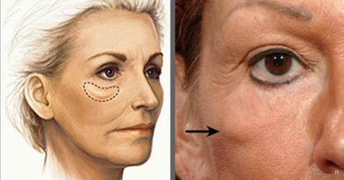 Как убрать мешки под глазами в 55 лет. Народная медицина: почему с возрастом появляются мешки под глазами, как от них избавиться
