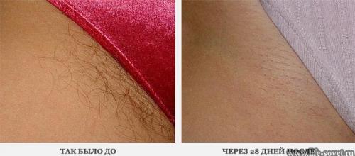 Как удалить волосы в интимных местах в домашних условиях навсегда. 