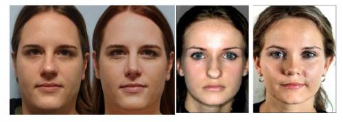 Форма носа картошка. Нос картошкой и ринопластика: до и после, как исправить