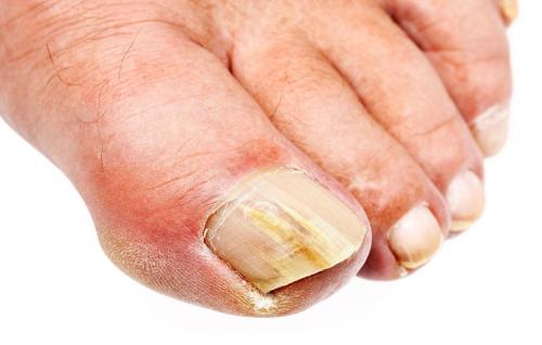 Как на ногтях отражаются болезни. Виды и причины развития заболеваний ногтей на ногах
