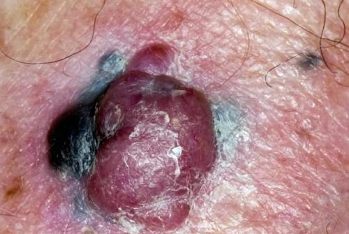 Выдавила прыщ на родинке. Прыщ на родинке