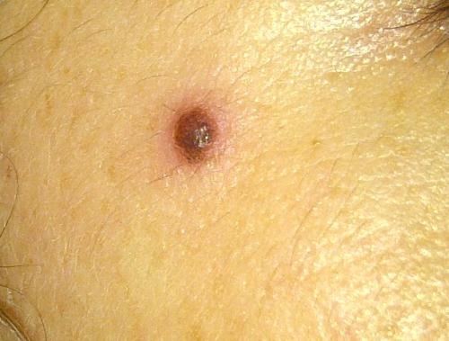 Выдавила прыщ на родинке. Прыщ на родинке