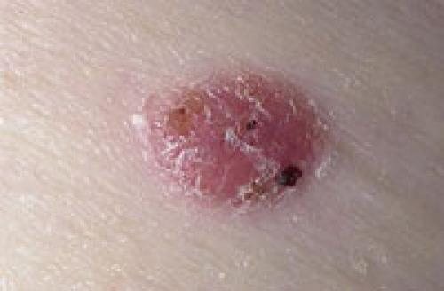 Как определить родинка или прыщ. Причины появления прыща на родинке 01 Как определить родинка или прыщ. Причины появления прыща на родинке 01