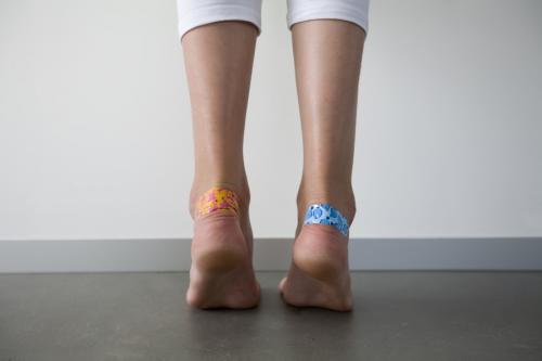 Мозоль на ноге болит. Лопнула мозоль на ноге