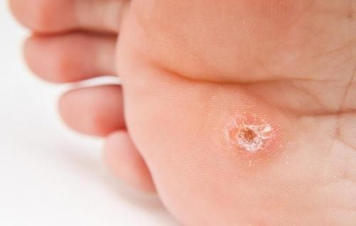 Мозоли на ногах. Лопнула мозоль на ноге