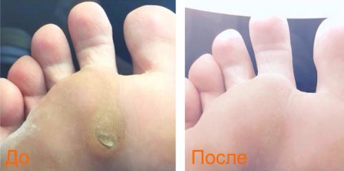 Удаление мозолей лазером.