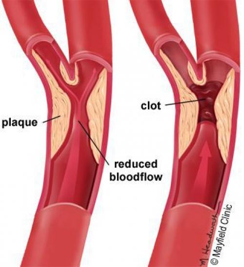 Осмотр стоп при диабете. Описание проявлений «Диабетическая стопа» 02