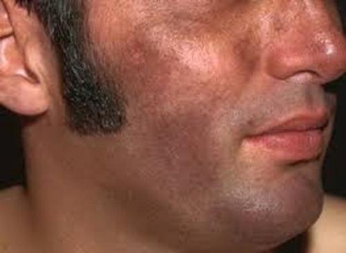 Как избавиться от пигментных пятен. Почему появляются пигментные пятна 09