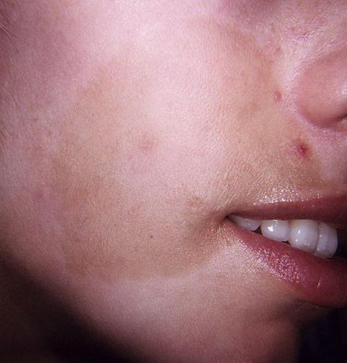 Как избавиться от пигментных пятен. Почему появляются пигментные пятна 08