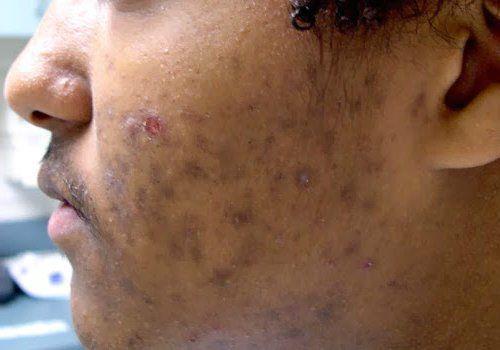 Как избавиться от пигментных пятен. Почему появляются пигментные пятна 05