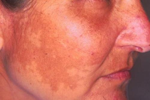 Как избавиться от пигментных пятен. Почему появляются пигментные пятна 03