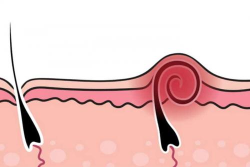 Можно ли избежать появления вросших волос. Причины появления вросших волос 09 Можно ли избежать появления вросших волос. Причины появления вросших волос 09