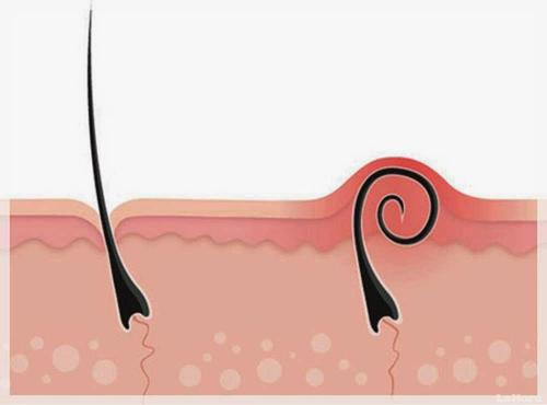 Вросшие волосы после шугаринга в зоне бикини. Вросшие волосы в паху