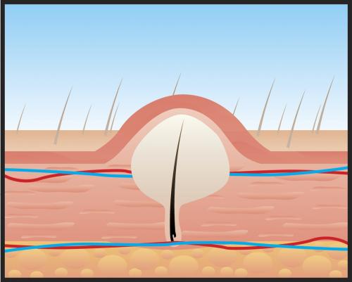 Вросшие волосы после шугаринга в зоне бикини. Вросшие волосы в паху