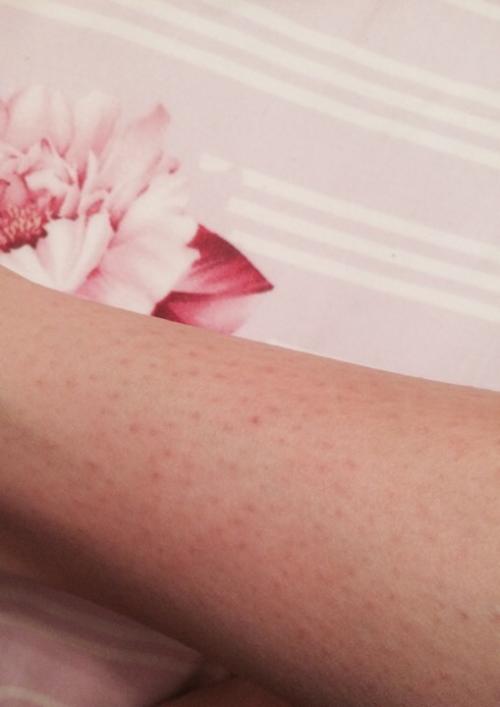 Побочные эффекты после разных видов депиляции. Виды депиляции 06