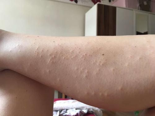 Пятна после шугаринга. Почему появляется раздражение после шугаринга?