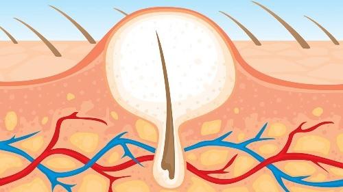 Вросшие волосы после эпиляции. Удаление вросших волос 10 Вросшие волосы после эпиляции. Удаление вросших волос 10