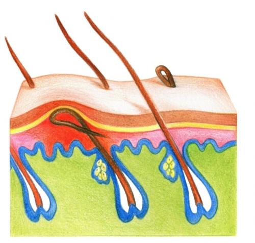 Вросшие волосы после эпиляции. Удаление вросших волос 08 Вросшие волосы после эпиляции. Удаление вросших волос 08