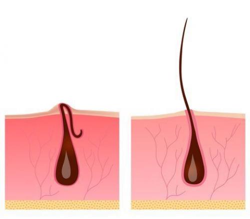 Вросшие волосы после эпиляции. Удаление вросших волос 09 Вросшие волосы после эпиляции. Удаление вросших волос 09