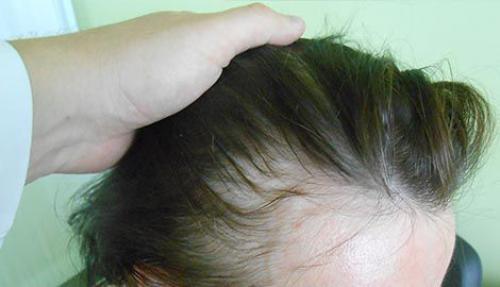 Волосы сильно выпадают анализы сдать. Диффузная сифилитическая алопеция. Диффузная алопеция у женщин. Сильное поредение волос у девушек. Выпадение волос после Кавида.