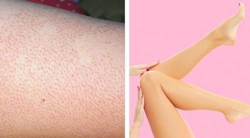 Что такое клубничные ноги и как от них избавиться. Бритье без последствий: как избавиться от эффекта “клубничных ножек” 01