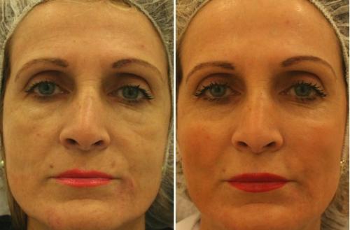 Аппаратная косметология для омоложения лица. Аппаратные процедуры