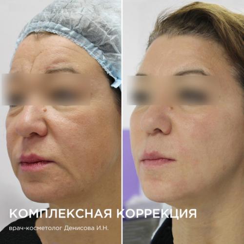 Аппаратная косметология для омоложения лица. Аппаратные процедуры