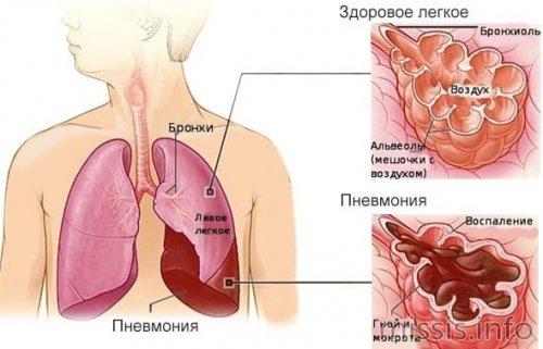 Температура и течение заболевания коронавирусом: основные факты и рекомендации 05