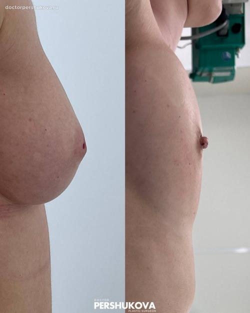 Как улучшить форму и поднять соски: практические советы и упражнения 08