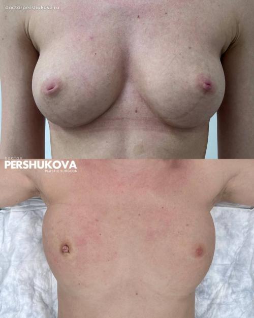 Как улучшить форму и поднять соски: практические советы и упражнения 09