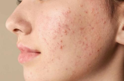Как избежать высыпания на лице. Что такое прыщи