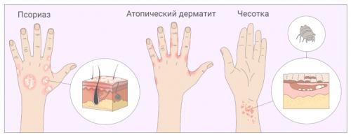 Как устранить угревающий зуд на коже летом. Почему чешется кожа?