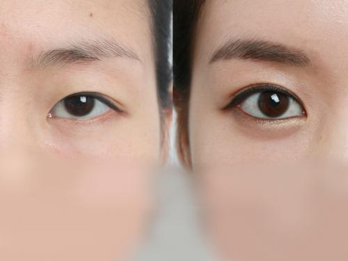 Как увеличить глаза пластика. Как сделать разрез глаза больше