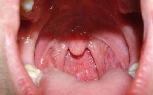 Болит горло без температуры и насморка. Как вылечить сильную боль в горле при глотании и в чем причины ее возникновения