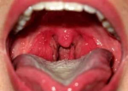 Болит горло, больно глотать температуры нет. Тонзиллит