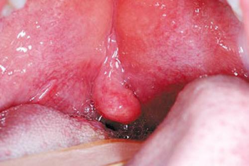 Болит горло без температуры и насморка. Как вылечить сильную боль в горле при глотании и в чем причины ее возникновения